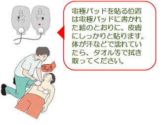 電極パッドを貼る位置は電極パッドに書かれた絵のとおりに、皮膚にしっかりと貼ります。体が汗などで濡れていたら、タオル等でふき取ってください。